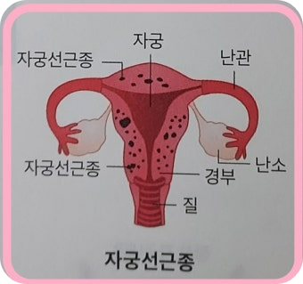 자궁선근종 , 생리통이 점점 심해진다면 의심