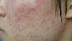 지루성 피부염 완치하려면