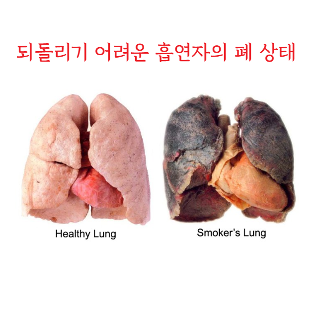 폐암-4기-생존률