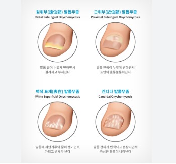 손발톱 무좀