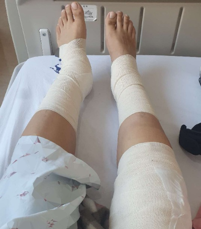 관절염 환자 사진