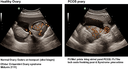 정상 난소와 다낭성 난소의 초음파 비교