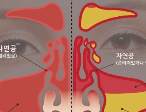 코감기와 비염은 어떻게 다른가요?
