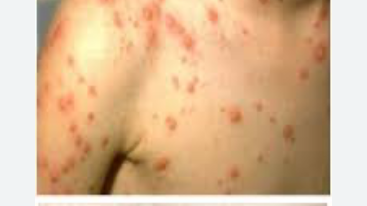 엠폭스-증상사진-감염경로