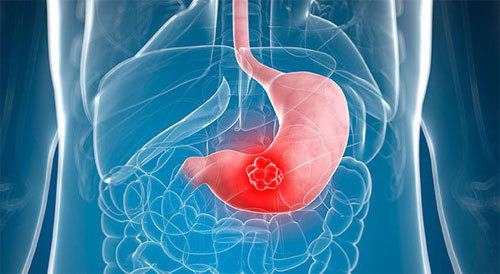 위장병에 좋은 음식 채소 야채 과일 종류