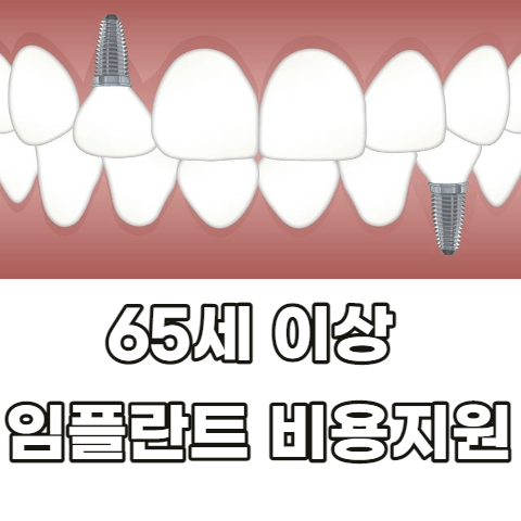 임플란트