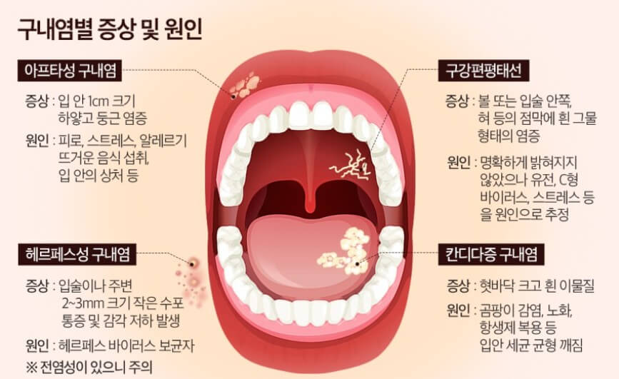구내염별 증상 및 원인 설명