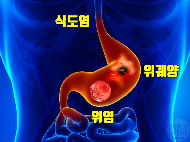 명치가 아파요 명치 통증 원인