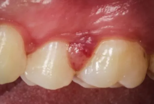 잇몸이-붓고-아플때-이유-해결방법-건강