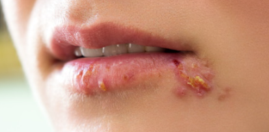 입술포진3