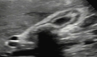 만성 담낭염 (Chronic cholecystitis)