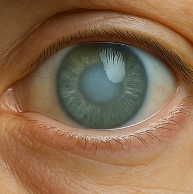 녹내장 초기증상