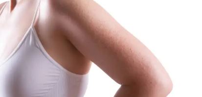 피부 뾰루지가 팔 전체에 난 사진