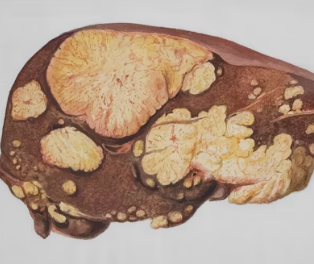 오른쪽 갈비뼈 아래 통증 원인 대처법