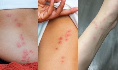 빈대 물린 자국