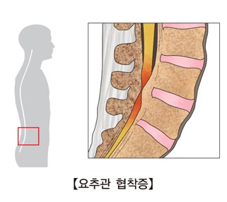 퇴행성 협착증