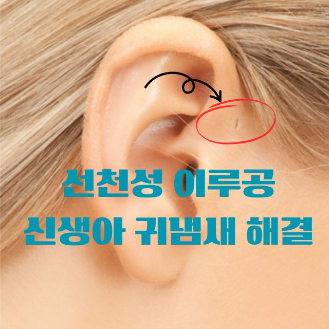 선천성 이루공