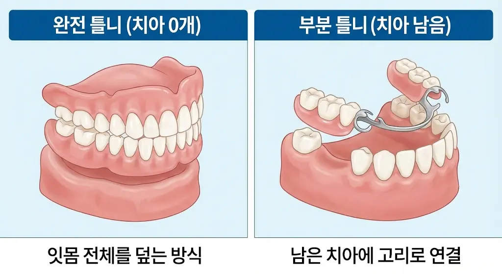 완전 틀니 부분 틀니