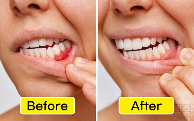 잇몸 염증 피나고 부었을때 좋은 자연치유 관리법 치은염 치료