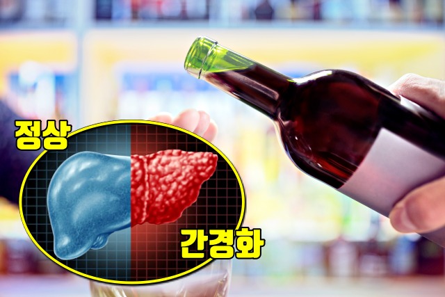 술, 음즈, 간경화, 간경변, 간암, 음식