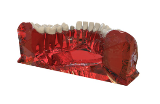 수면 임플란트 비용 과정