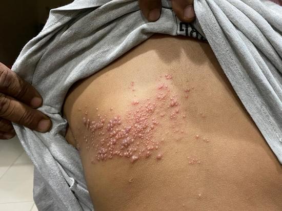 대상포진 (Shingles): 원인, 증상, 치료 및 예방