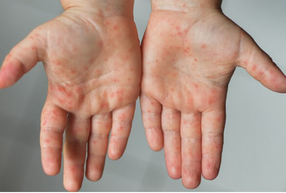 수족구 증상이 손바닥에 나타남