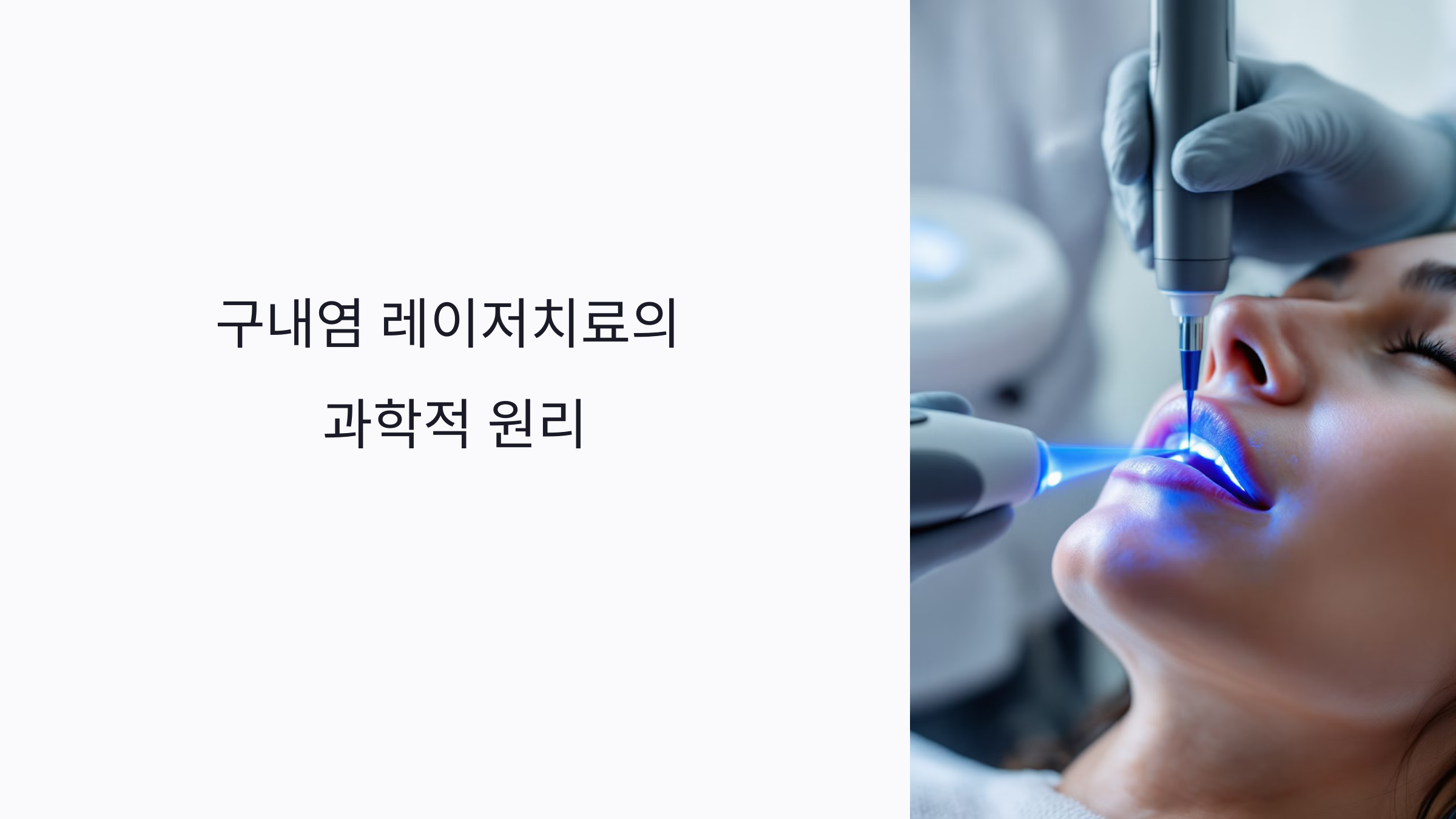 연구로 입증된 구내염 레이저치료 효과