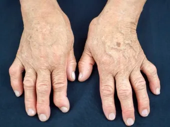 효과적인 류마티스 관절염 치료제 추천 약물 비교 가이드 2025 최신판_7