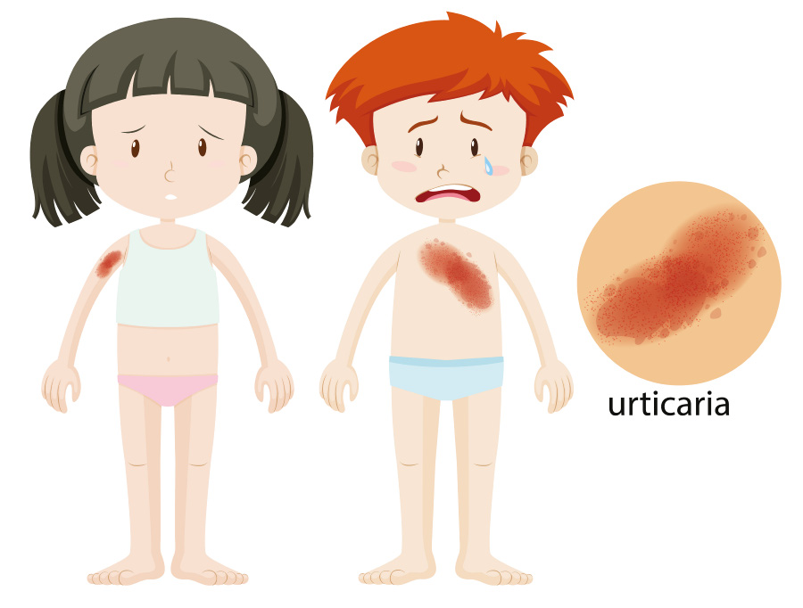왼쪽 여자 어린이의 오른쪽 팔뚝과 오른쪽 남자 어린이의 왼쪽 가슴에 빨간 두드러기가 발생된 것을 그린 그림 사진