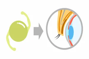 렌즈삽입술-가격