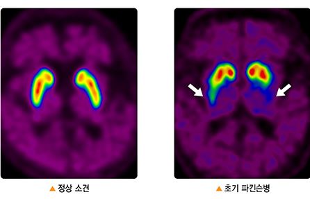 파킨슨병 초기증상