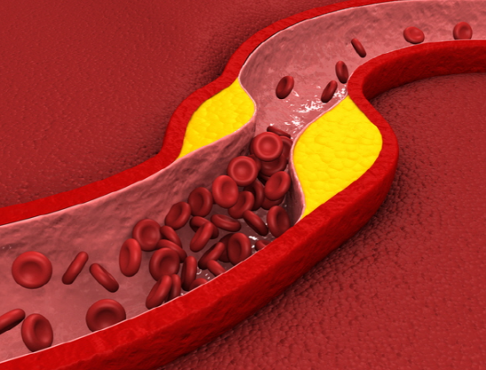 동맥경화증 초기증상