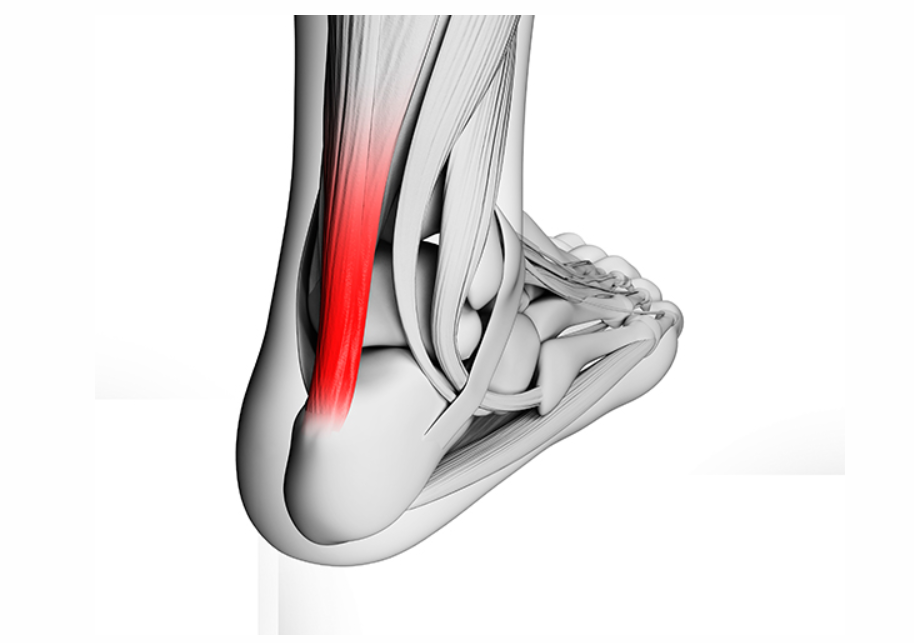 아킬레스건염