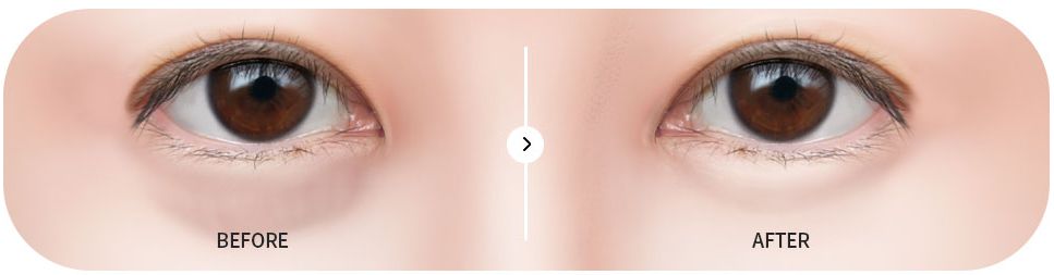 눈밑지방재배치수술