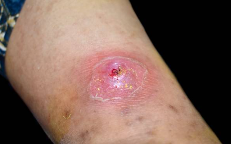 독성 쇼크 증후군과 관련된 사진2