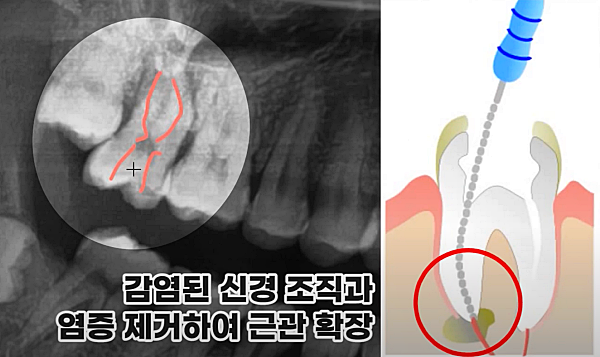 재신경치료과정, 염증 제거 및 소독_출처:유튜브라이브치과병원