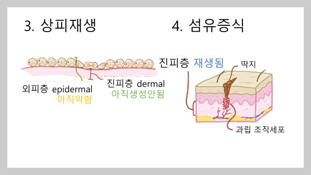 상처 쉬운 치료 방법과 관리: 수술 상처, 다친 상처, 흉터 관리.