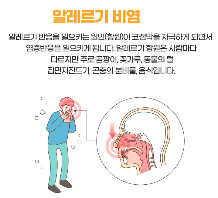 알레르기 비염