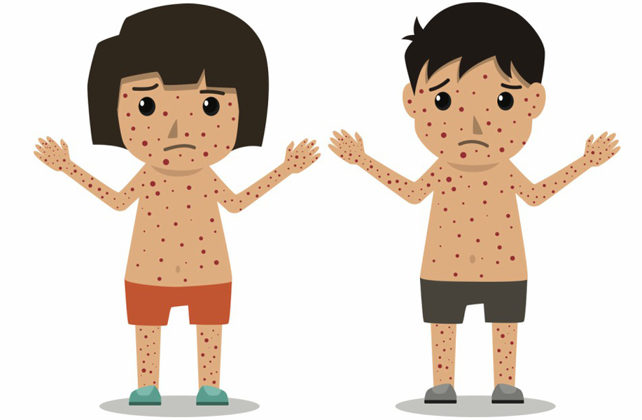 홍역과 수두-차이점