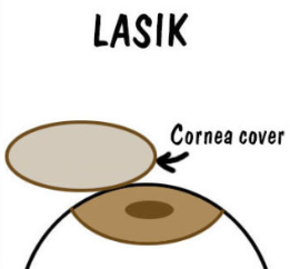 투데이라섹 수술 후기
