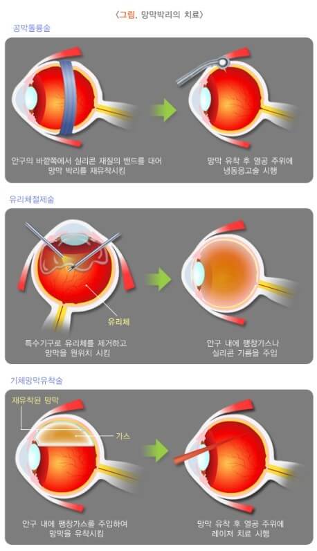 망막박리 치료