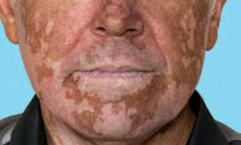 백반증 초기증상 10