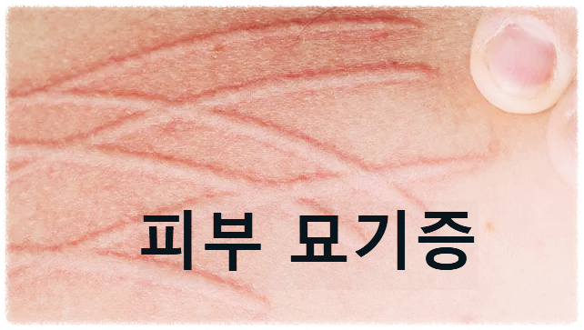 피부 묘기증 관련 이미지