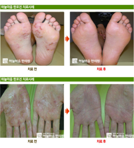 남자 사타구니 습진