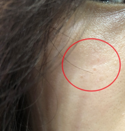 트레티노인연고부작용