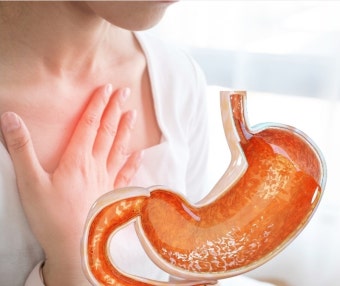 역류성 식도염 치료 및 관리방법 알아보기