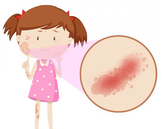대상포진-초기-증상-합병증-4
