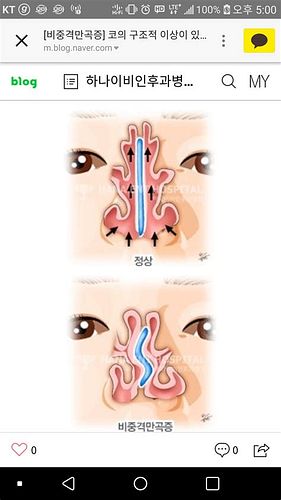 비중격만곡증수술
