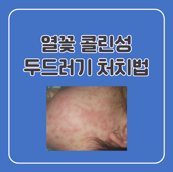 아기 열꽃 두드러기, 콜린성 두드러기 대처법